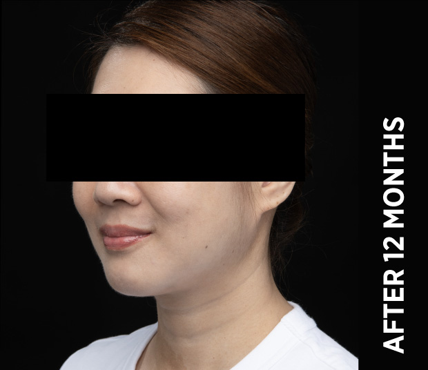 Ba Face3 After 12months Nz
