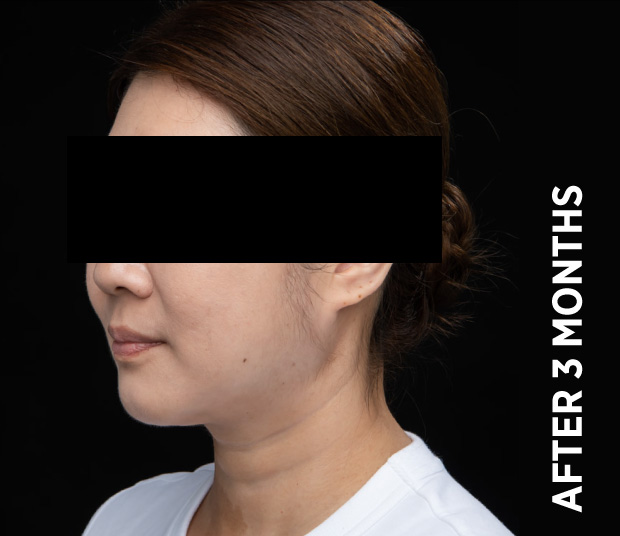Ba Face3 After 3months Nz