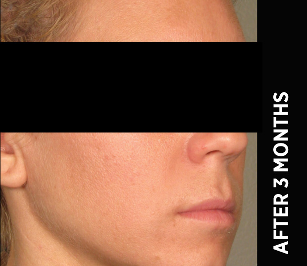 Ba Face4 After 3months Nz
