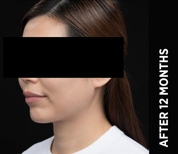 Ba Face5 After 12months Nz
