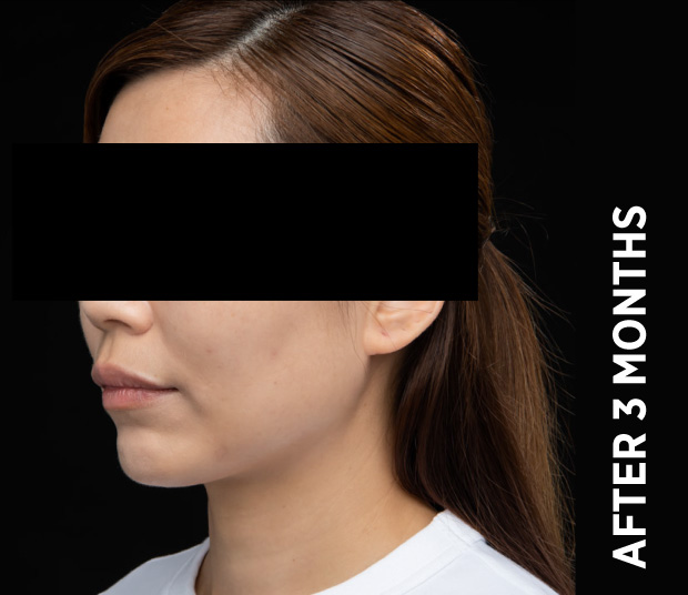 Ba Face5 After 3months Nz