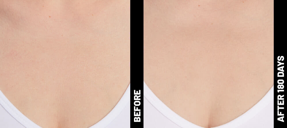 Blinder Grace Decolletage After 180