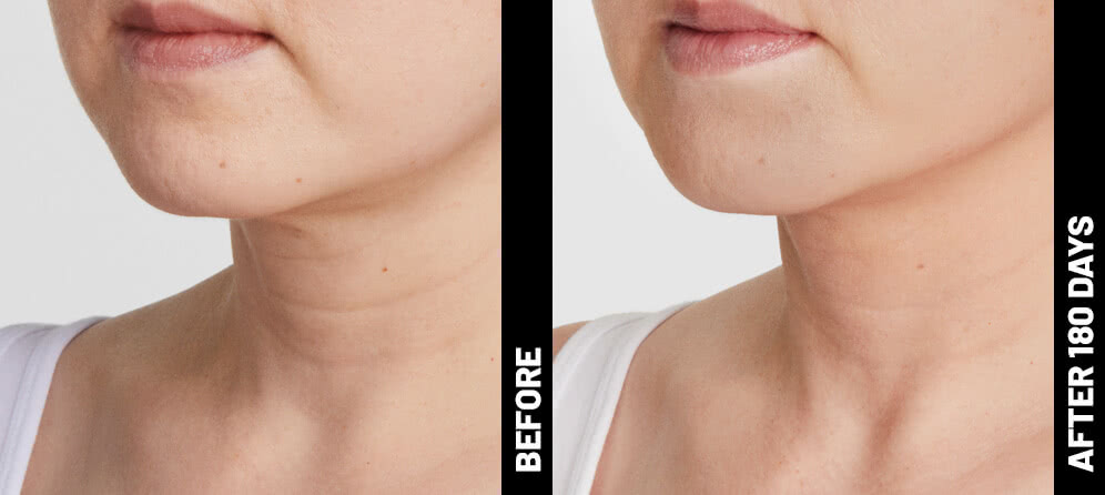 Blinder Grace Neck After 180
