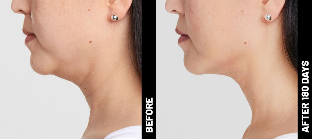 Blinder Grace Profile After 180